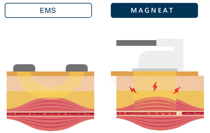 magneat ems difference